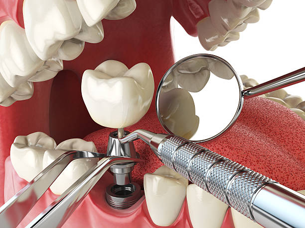 Best Emergency Dental Care for Abscessed Tooth in Bellevue, OH